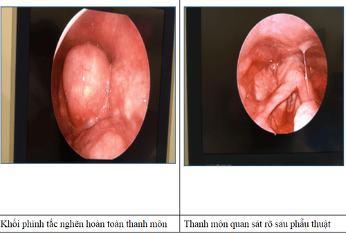 Vinmec Nha Trang timely intervened in a rare complication of epiglottis abscess