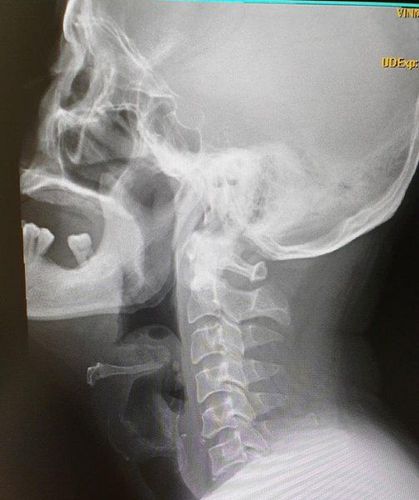 
X-ray image showed the abscess pressing the patient’s entire airway with epiglottitis
