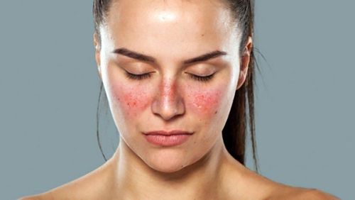 Các dấu hiệu điển hình của bệnh lupus ban đỏ