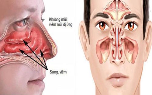 Viêm xoang mũi có dịch điều trị dứt điểm thế nào?