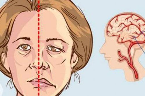 Liệt dây thần kinh số 7 kèm méo miệng có sao không?