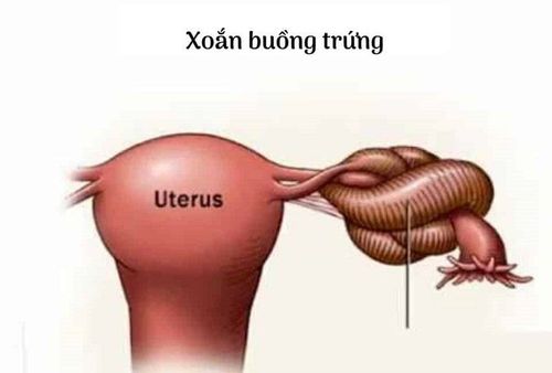 Xoắn buồng trứng nguy hiểm thế nào?