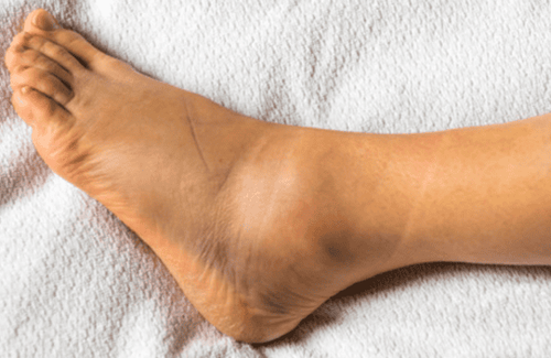 Bị trẹo cổ chân bao lâu thì khỏi?