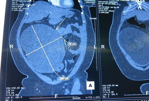 
CT scan results showed a large tumor up to 25cm in diameter.
