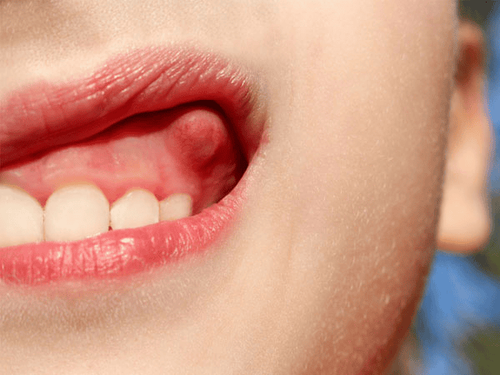 Trẻ bị áp xe nướu răng có nguy hiểm?