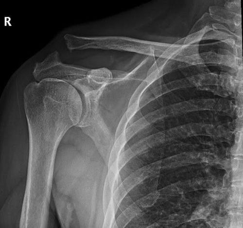 
Image 1: X-ray image of a patient with chronic dislocation of right acromioclavicular joint dislocation
