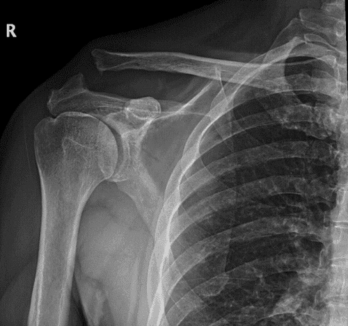 Chronic Acromioclavicular Joint Dislocation