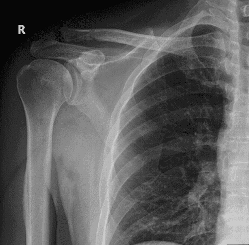 
Image 6: Preoperative x-ray image (left) and postoperative x-ray image (right) taken in a re-examination 6 weeks post-surgery. The acromioclavicular joint has returned to its anatomical position.
