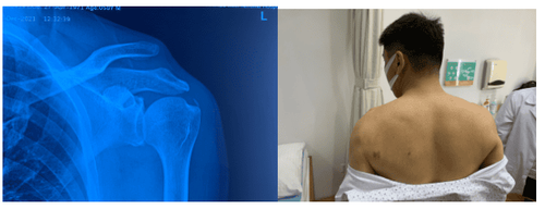 
Image: A patient's X-ray showing a dislocated clavicle (left) and the patient's clinical condition (right)
