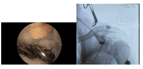 
Image of inserting the tightrope's thread into the tunnel (left), showing how to verify the shoulder blade's joint again after it has been mended with a C-arm (right)
