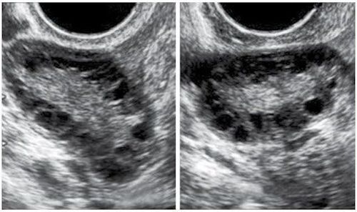 Hình ảnh siêu âm buồng trứng đa nang với đầu dò âm đạo.