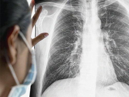 Ung thư phổi giai đoạn 4 sống được bao lâu và những yếu tố ảnh hưởng