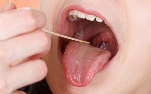 Ung thư vòm họng giai đoạn đầu có chữa được không?