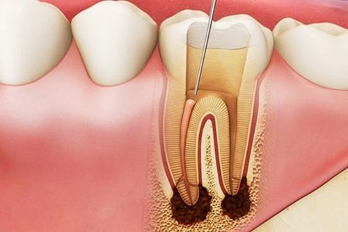 Răng đã lấy tủy tồn tại được bao lâu?