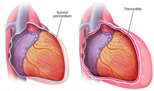 Tràn dịch màng ngoài tim điều trị thế nào?