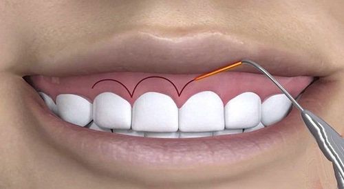 Cắt nướu răng có ảnh hưởng gì không?