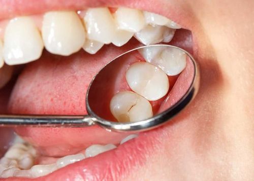 Bị răng sâu nhẹ có nên trám?