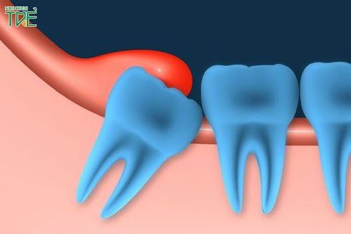 Viêm quanh thân răng cấp – Triệu chứng và cách điều trị