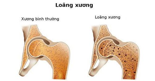 
Hình ảnh loãng xương
