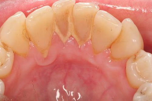 Quy trình lấy cao răng sẽ như thế nào?