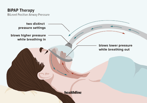 
Bi-level Positive Airway Pressure (BiPAP) machine
