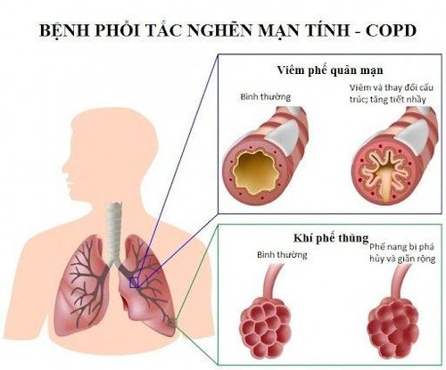 
Hình ảnh bên trong hệ hô hấp ở bệnh nhân có bệnh phổi tắc nghẽn mạn tính
