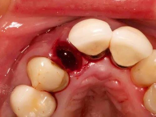 Chảy máu sau nhổ răng – Nguyên nhân và xử trí