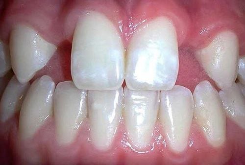 Hypodontia – Tình trạng thiếu răng