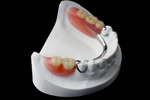 Hàm khung (Dental partial denture) – Tổng quan