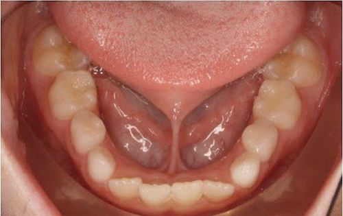 Phanh lưỡi và tình trạng dính phanh lưỡi