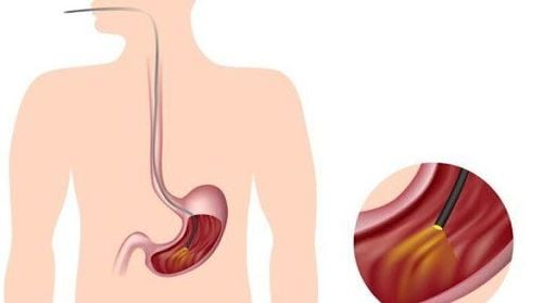 
Nội soi đường tiêu hoá là phương pháp tầm soát ung thư hiệu quả nhất
