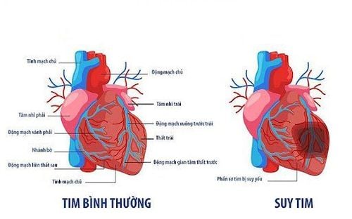 
Hình ảnh khi bị suy tim
