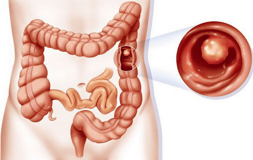 Sau phẫu thuật ung thư đại tràng nên ăn gì, kiêng gì? Các lưu ý quan trọng