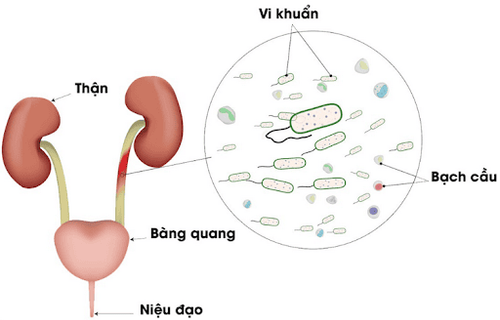 
Hình ảnh viêm tiết niệu
