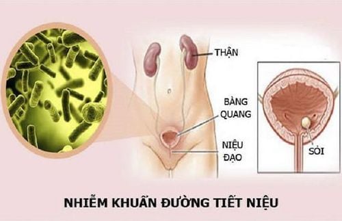 
Phòng ngừa nhiễm khuẩn tiết niệu hiệu quả bằng cách làm sạch bộ phận vùng kín
