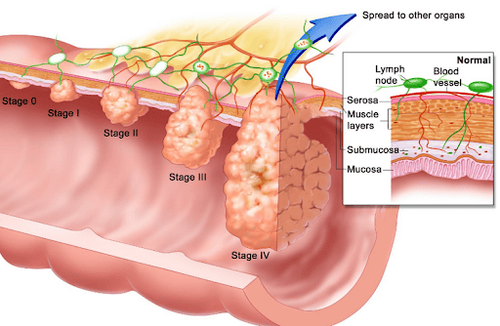 
Hình ảnh ung thư đại tràng
