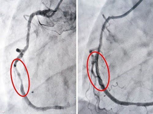 
Hình ảnh đặt stent mạch vành hiển thị trên màn hình
