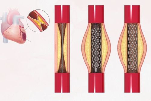 
Hình ảnh đặt stent mạch vành để mở rộng lòng mạch và cải thiện lưu thông máu
