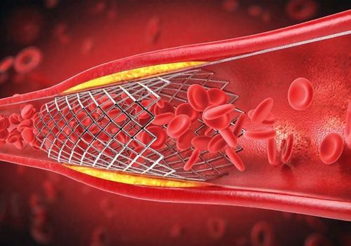 
Đặt stent để nong mạch vành, đảm bảo lượng máu lưu thông
