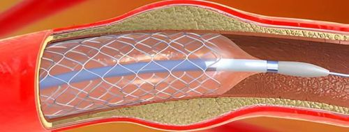 
Đặt stent phủ thuốc là lựa chọn an toàn cho bệnh nhân bị bệnh mạch vành
