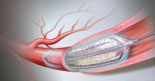 
Phương pháp nong động mạch vành bằng bóng phủ thuốc giúp giảm nguy cơ huyết khối cấp trong lòng stent
