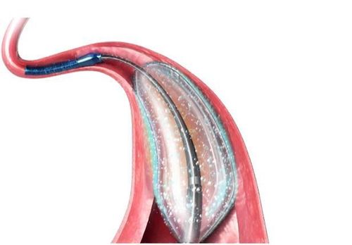 
Tái hẹp động mạch vành là một biến chứng của thủ thuật đặt stent
