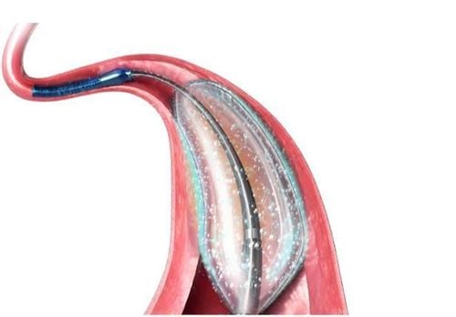 
Nong mạch vành và đặt stent ít xâm lấn hơn so với phẫu thuật bắc cầu mạch vành
