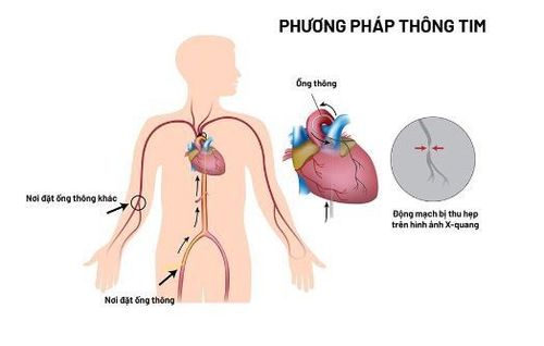 
Đặt ống thông tim giúp trẻ em khắc phục các vấn đề với van, mạch máu hoặc thành tim
