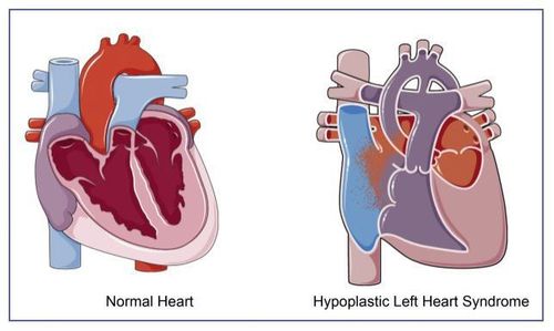 Hội chứng thiểu sản tim trái: Nguyên nhân, triệu chứng và điều trị