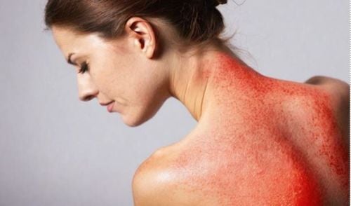 
Bệnh Lupus một bệnh tự miễn trong đó hệ miễn dịch tấn công các cơ quan khỏe mạnh
