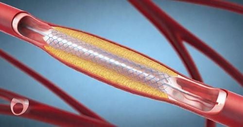 
Stent phủ thuốc là một trong những phương pháp điều trị bệnh tim mạch, giảm nguy cơ tái hẹp mạch vành
