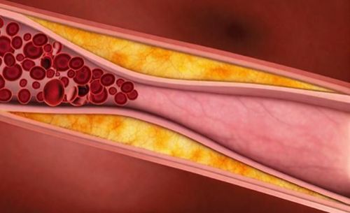 
Ceramides liên quan đến chứng xơ vữa động mạch
