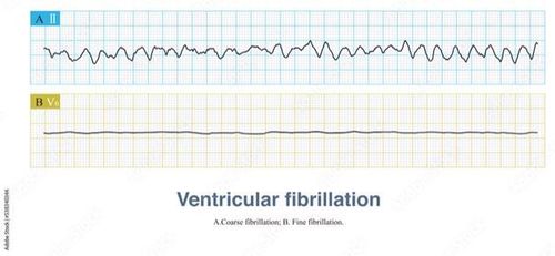 
Rung tâm thất sóng lớn và rung tâm thất sóng nhỏ sẽ có những biểu hiện trên ECG khác nhau
