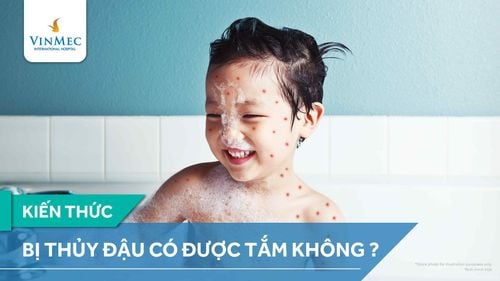 Gãi nhiều, kiêng tắm có thể gây nhiễm trùng da ở người bị thủy đậu